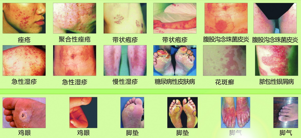 皮膚癬、濕疹、腳氣、腳墊、雞眼